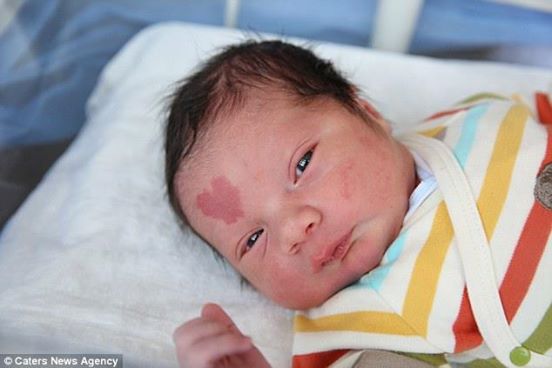 Kind der Liebe: Foto von Baby mit seltenem Mal auf der Stirn geht um die Welt.