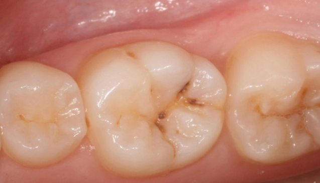 Reibe diese zwei Öle auf dein Zahnfleisch und deine Zähne und du wirst wahrscheinlich keinen Zahnarzt mehr brauchen