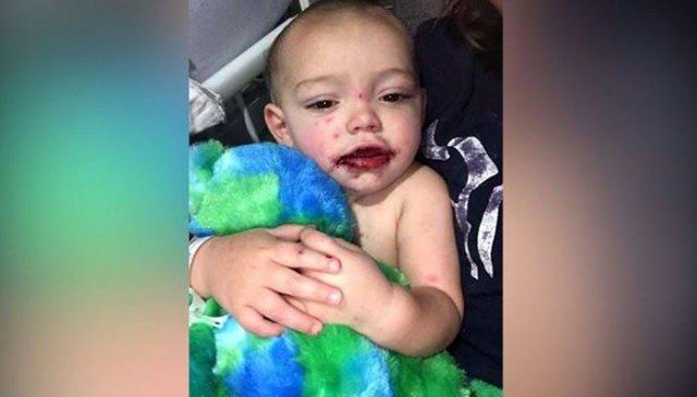 Mama entdeckt blutige Blasen im Mund ihres 1 jährigen – die Diagnose des Arztes lässt sie am Boden zerstört