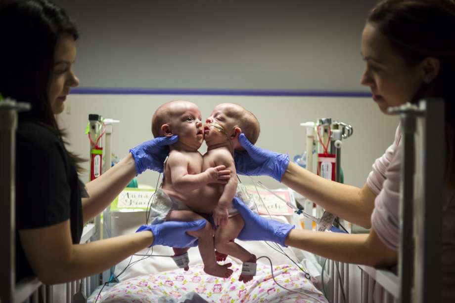 Siamesische Zwillinge nach 7 stündiger Operation getrennt – sehen Sie, wie sie nach der einzigartigen Operation aussehen