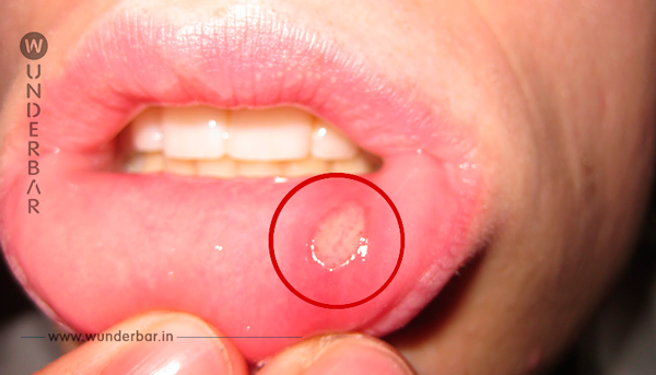 Wenn du diesen weißen Fleck in deinem Mund entdeckst, solltest du sofort handeln. Diese 5 Hausmittel wirken Wunder.