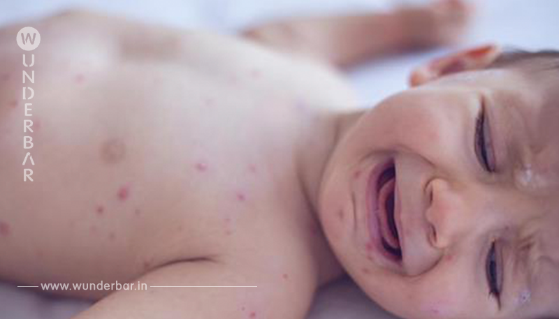 Nachdem ein 11 Monate altes Baby einen Schlaganfall erleidet, empfehlen Ärzte Eltern nicht die Impfungen ihrer Kinder zu vernachlässigen