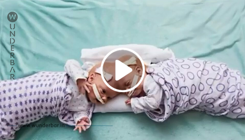 Siamesische Zwillinge können endlich nach Hause in verschiedene Bettchen, nachdem gefährliche Operation erfolgreich verlief