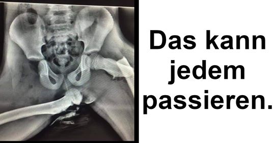Unfall: Röntgenbild zeigt zerschmetterte Hüfte von Frau