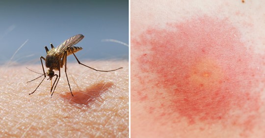 Mückenstiche mit Hitze behandeln