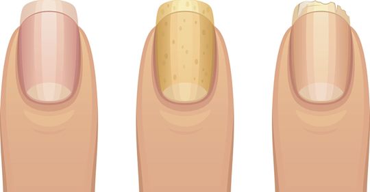 Fingernägel: Was Nägel über die Gesundheit sagen
