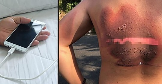 Junge (15) erleidet Verbrennungen 2. Grades – Handy-Ladegerät war neben seinem Bett explodiert, als er schlief