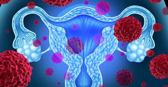 2 unsichtbare Risikofaktoren begünstigen Eierstockkrebs – wann Sie zum Arzt müssen