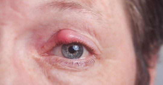 Gerstenkorn am Auge: Symptome & Hausmittel