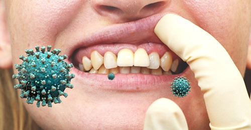 Corona: Chronische Zahnfleischentzündung könnte schweren Verlauf begünstigen!
