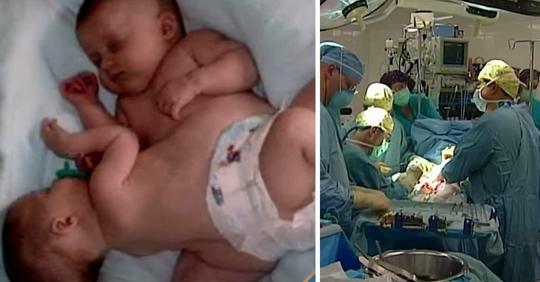 Siamesischer Zwilling bekommt trotz aller Widrigkeiten Kind – dabei rieten Ärzte davon ab