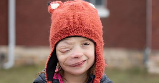'Sie akzeptiert sich einfach'– 10-jähriges Mädchen wird wegen eines seltenen Tumors im Gesicht schikaniert