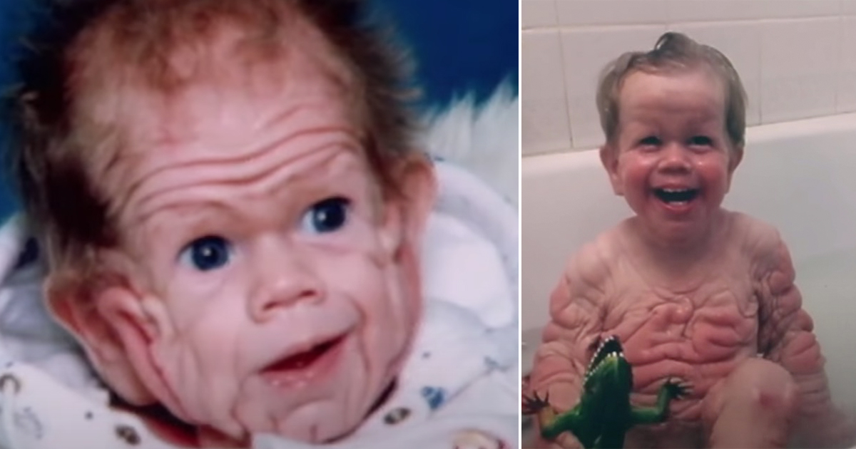 Tomm Tennent: Das einzigartige Baby mit der ungewöhnlichen Haut – Wie geht es ihm heute, 28 Jahre später?