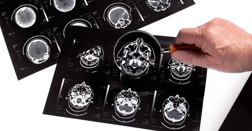 Studie bestätigt: Corona erhöht das Alzheimer Risiko