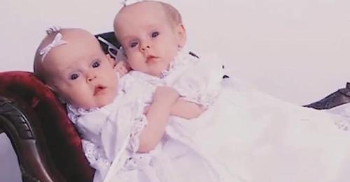 Diese siamesischen Zwillinge waren 2002 berühmt, 11 Jahre später sind sie im Fernsehen und erzählen über ihr getrenntes Leben