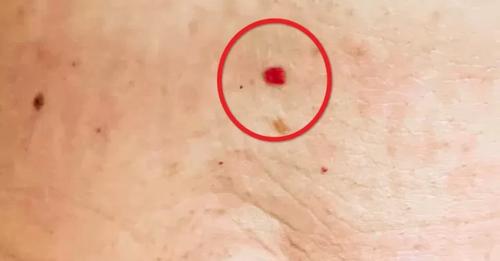 Sie erscheinen von einem Tag auf den anderen auf dem Körper: Was bedeuten diese roten Punkte?