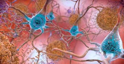 Neue Hinweise auf Übertragbarkeit von Alzheimer: Wie aussagekräftig ist die Studie?