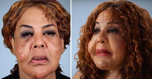Bösartige 'Ärztin' pumpte ihr Gesicht mit Zement voll – so sieht sie heute aus